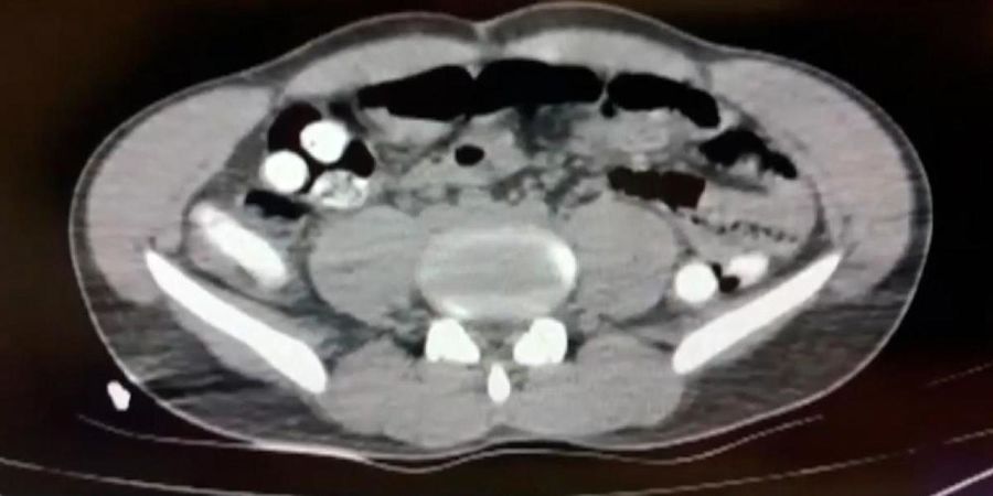 کشف ۱۰۲ کپسول تریاک در معده مسافر ایرانی+ فیلم
