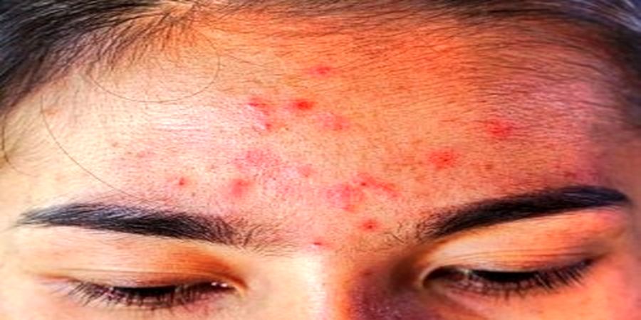 بهترین روش های درمان سریع جوش و آکنه روی پیشانی