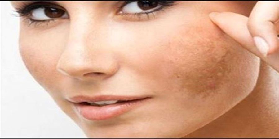 با این روش  ساده دو روزه لک های صورتتان را از بین ببرید 
